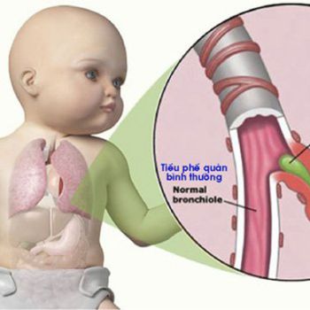 Viêm tiểu phế quản: Nguyên nhân, triệu chứng và cách điều trị