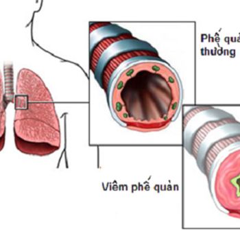 Viêm phế quản cấp: Thông tin tổng quan và cách trị dứt điểm