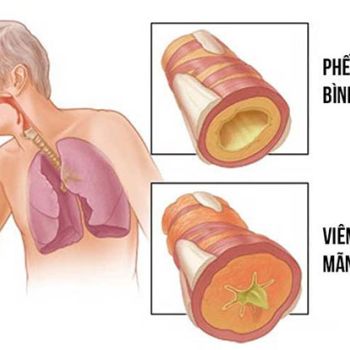 Viêm phế quản mạn tính: Triệu chứng và cách điều trị